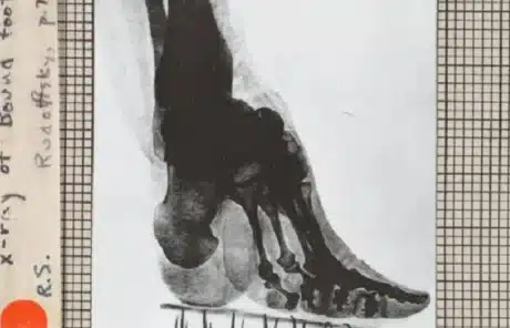 X-ray views of bound feet - China Xian Tour: Private & Tailor-Made China Tours X-ray views of bound feet